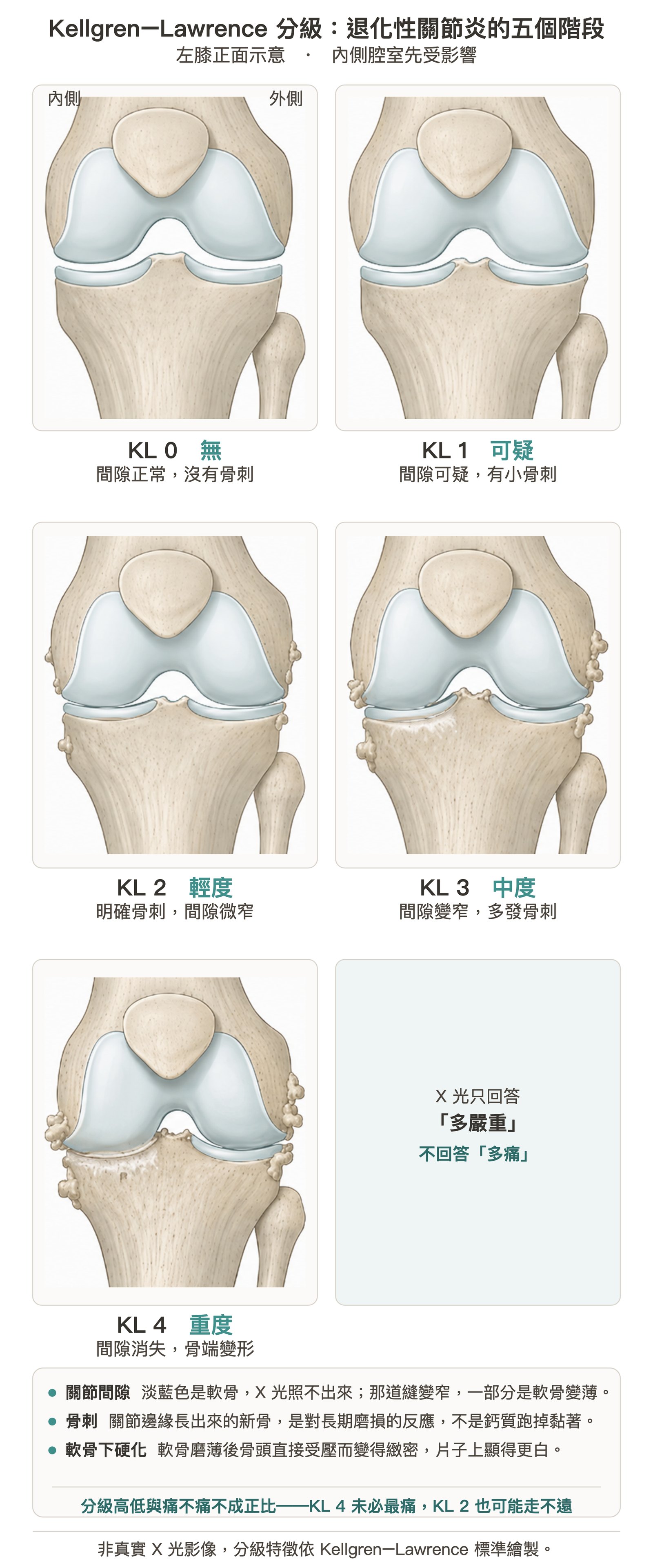 X 光在退化性關節炎裡的角色不是「有沒有病」，而是「多嚴重」。從 0 級到 4 級，內側的關節間隙一路變窄、骨刺一路長大——但要記得，影像上的分級和你實際有多痛，並不總是成正比。